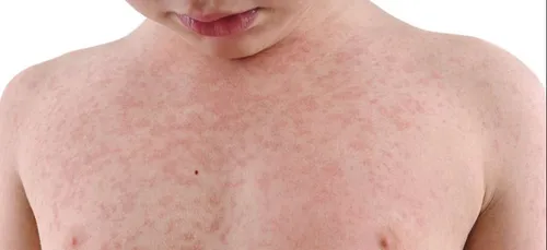 Rougeole : l'épidémie s'étend en France, le Nord touché