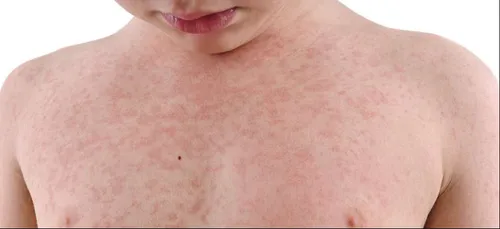 Rougeole : Déjà 1 500 cas recensés en 2018 en France, la région pas...