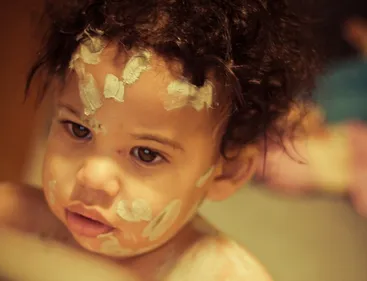 La varicelle sévit dans les Hauts de France