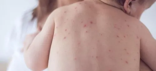 Quiévrechain : un nourrisson meurt des complications de la varicelle