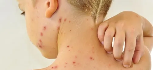 L'épidémie de varicelle se poursuit dans les Hauts-de-France