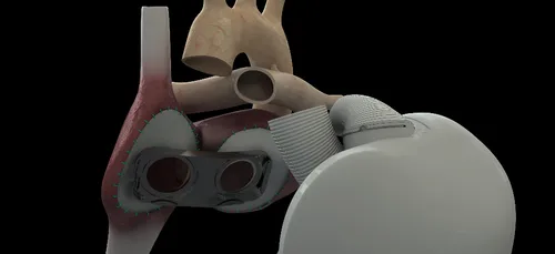 Coeur artificiel : Carmat y croit