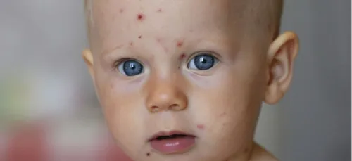 Nouvelle offensive de la varicelle