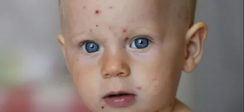 Nouvelle offensive de la varicelle