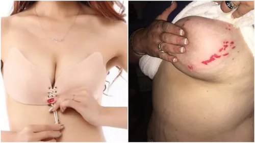 Un soutien-gorge à la mode accusé de provoquer de graves brûlures