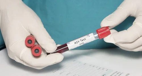 Sida : le taux de mortalité a été divisé par deux depuis 2005