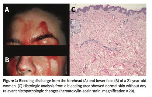 Italie : le mystère d'une jeune femme qui transpire du sang