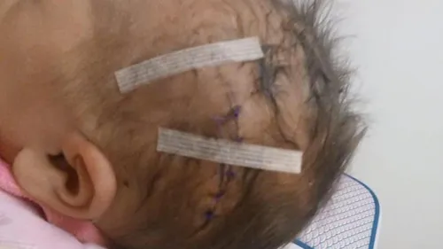 Un bébé blessé par un coup de scalpel lors d'une césarienne