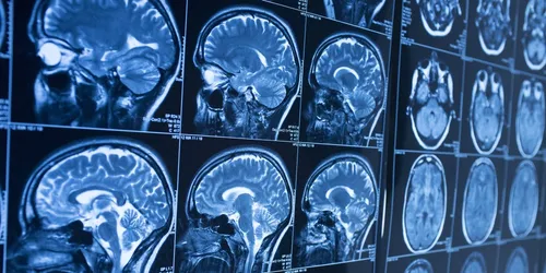 Le médicament Androcur suspecté d'augmenter le risque de tumeurs au...