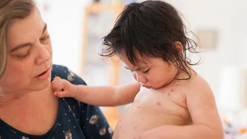 Une épidémie de varicelle touche la moitié de la France