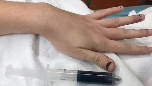 Une femme se présente à l'hôpital car son sang est bleu