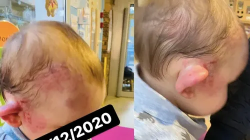 Un enfant de 15 mois retrouvé le visage tuméfié à la crèche par ses...