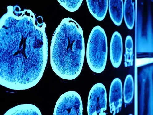 Un cancer très rare vaincu grâce à l'immunothérapie